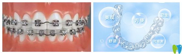 傳統(tǒng)矯正和隱形矯正對比圖