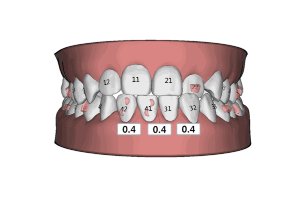 牙齒矯正動(dòng)態(tài)圖