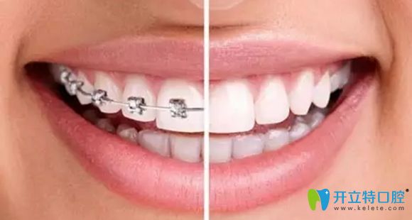 長沙牙齒矯正價格表