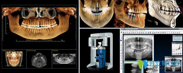 種植牙三大技術(shù)特點(diǎn)
