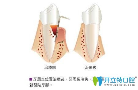 東營(yíng)鉑爾口腔郭振明介紹牙周炎治療方法