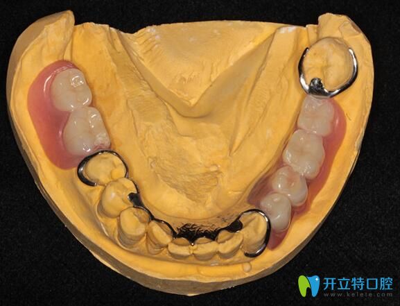廣州柏德口腔閆振介紹可摘局部義齒優(yōu)勢
