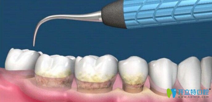 李懿來(lái)告訴大家為什么醫(yī)生不建議做齦下刮治？