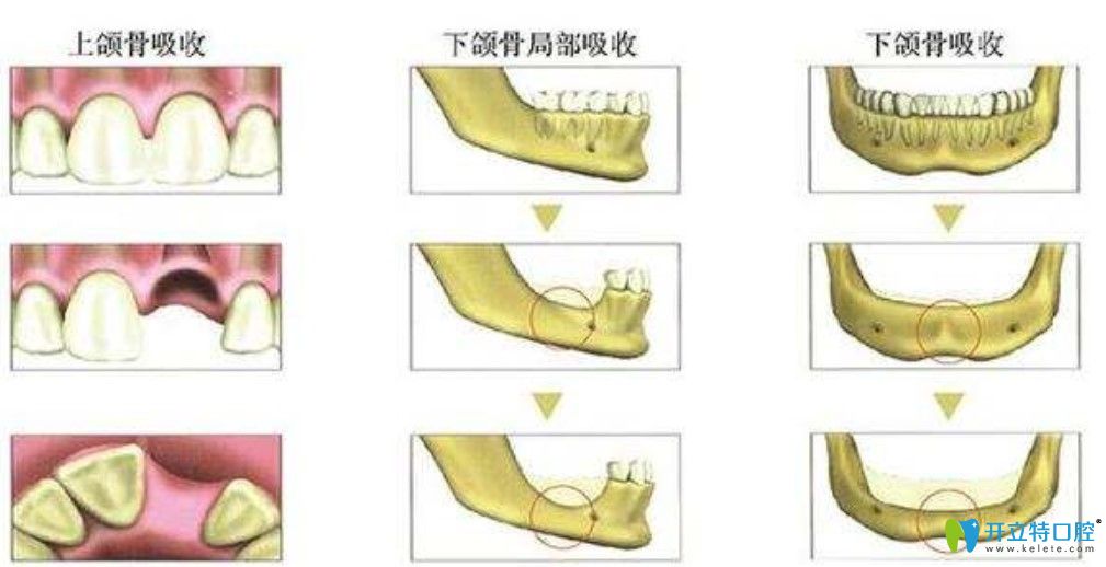 牙槽骨客觀條件過差會導致假牙脫落