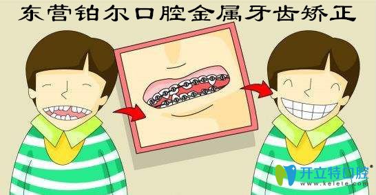 畸形牙齒矯正福利!東營鉑爾口腔金屬矯正8800元起免費拍牙片