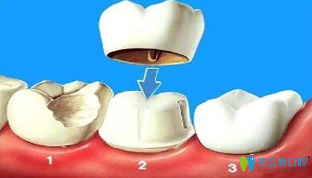 烤瓷牙必須磨牙嗎,磨牙需要磨多少?缺牙做烤瓷牙必看