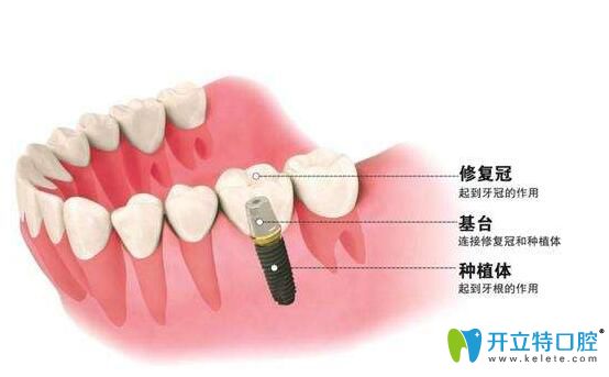 寧波恒美口腔李莎醫(yī)生介紹種植牙價(jià)格