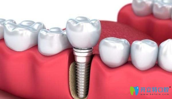 德國(guó)進(jìn)口種植牙圖