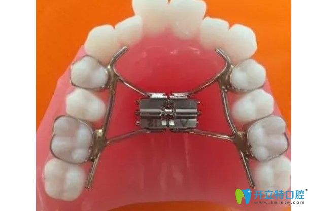 李可君講解牙齒矯正的擴(kuò)弓器利弊是什么