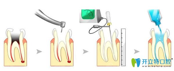 根管治療過(guò)程示意圖