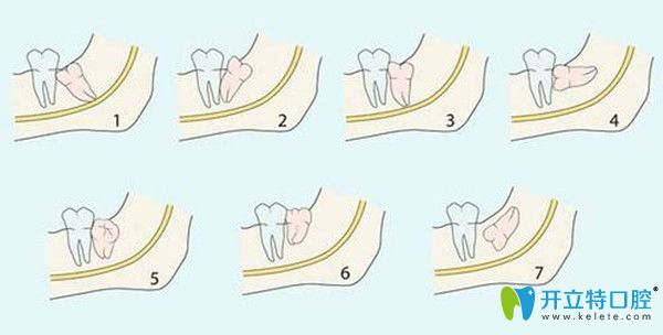 阻生智齒的七種情況 阻生智齒的七種情況