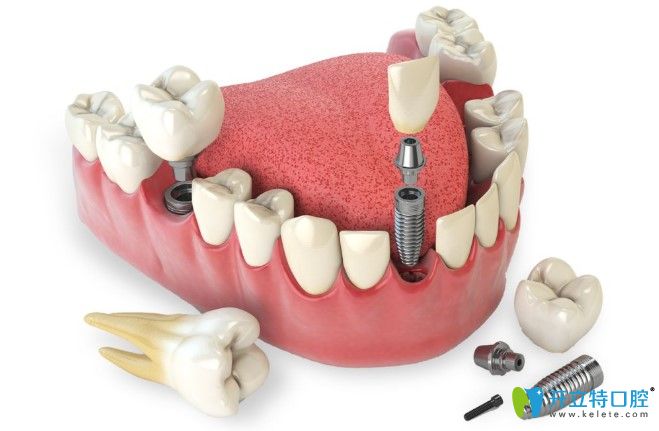 李奇?zhèn)メt(yī)生告訴你種植牙能用多長(zhǎng)時(shí)間
