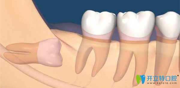 智齒齲壞要及時拔除 智齒齲壞要及時拔除