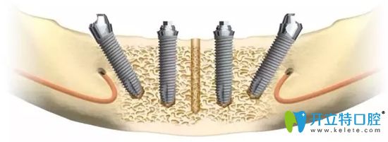 All-on-4半口種植修復技術示意圖