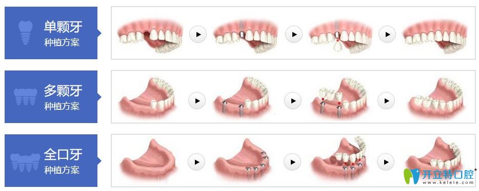 成都極光口腔種植牙技術(shù)