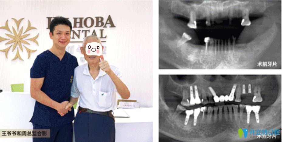 東莞好佰年口腔即刻種植牙對(duì)比