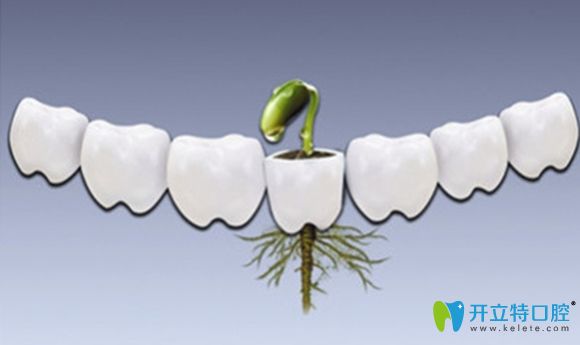 真相探求:種植牙哪個品牌好?瑞士iti就一定比奧齒泰好嗎?