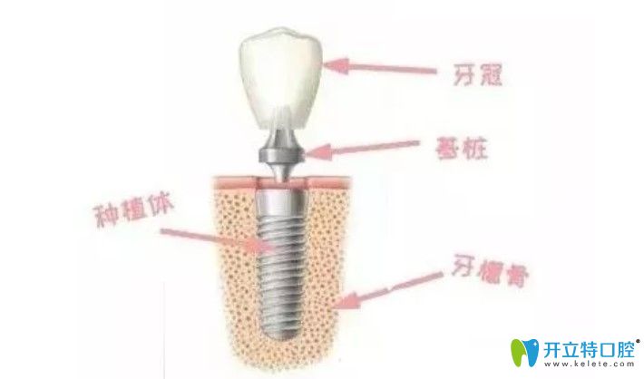 耿遠明醫(yī)生告訴你種植牙結(jié)構(gòu)
