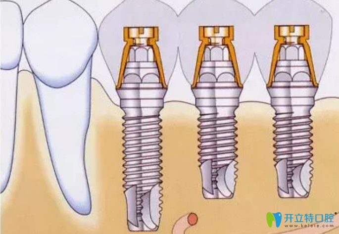 耿遠明醫(yī)生告訴你種植牙步驟