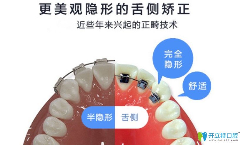 舌側隱形矯正缺點