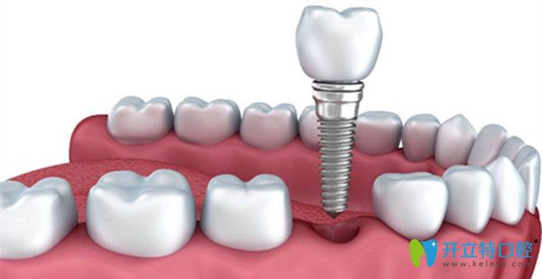 北樂口腔即刻種植技術(shù)