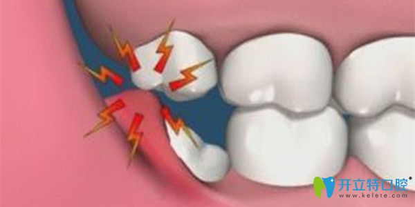 無(wú)相對(duì)咬合關(guān)系的智齒