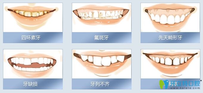 西諾德全瓷牙適用人群