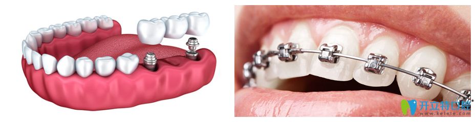 種植牙和牙齒矯正圖片
