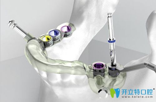 胡圖強講解什么是數(shù)字化種植牙