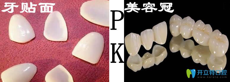 流行的牙齒美容方法牙貼面和美容冠哪個(gè)好,有什么區(qū)別？