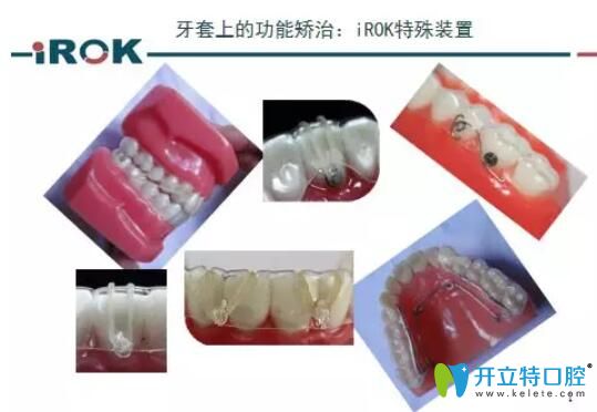 IROK矯治器的特點