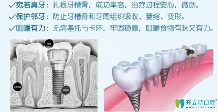 <!--<i data=20240703-sp></i>-->口腔的即刻負重種植牙技術(shù)