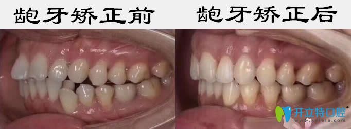 成人牙齒矯正可借鑒東營鉑爾口腔齙牙和牙齒擁擠矯正效果