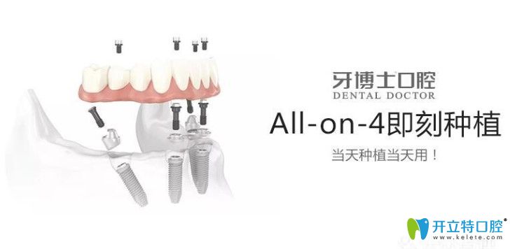 <!--<i data=20240703-sp></i>-->口腔的allon4種牙技術(shù)