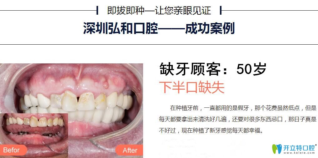 深圳弘和口腔鄭建偉醫(yī)生半口種植牙案例