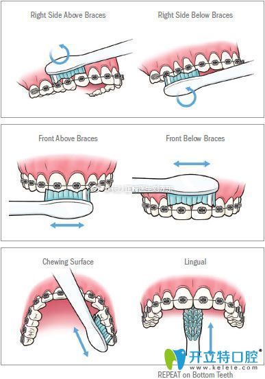 戴上牙套后的刷牙圖示