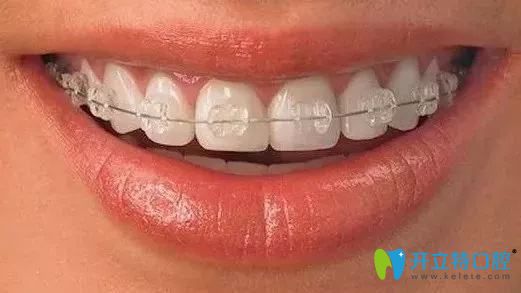 半隱形牙套會(huì)刮嘴?分享在做陶瓷托槽半隱形感受