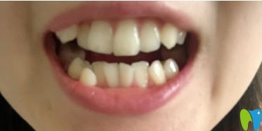 沒有進(jìn)行矯正前牙齒的樣子