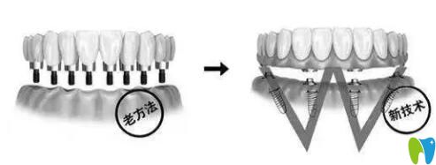傳統(tǒng)種植牙和AII-ON-4種植