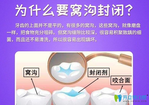 聽圣貝牙科醫(yī)生說為什么要窩溝封閉