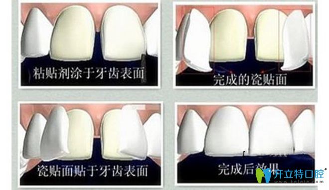 牙齒貼面步驟圖解