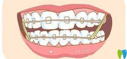 牙齒矯正的原理是什么