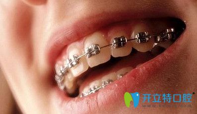 德貝口腔傳統(tǒng)金屬托槽矯正
