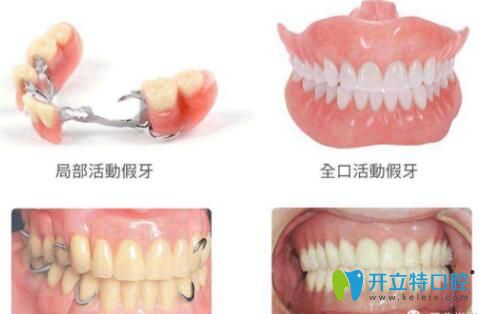 深圳鑲牙技術(shù)哪家好?整理鑲牙價(jià)格和烤瓷牙好的醫(yī)院供參考