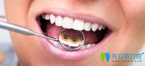 舌側矯正效果圖