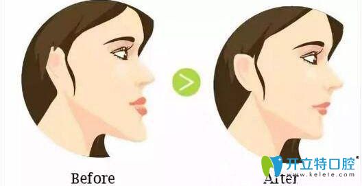 正畸難度不同費(fèi)用有差異