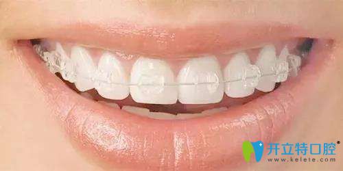 傳統(tǒng)透明托槽矯正圖片