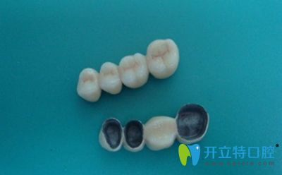 李會彬醫(yī)生簡介烤瓷冠橋修復(fù)方法