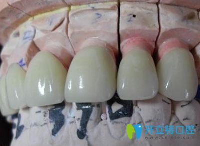 全瓷冠修復(fù)效果圖