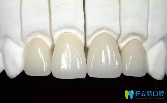 <!--<i data=20240703-sp></i>-->全瓷牙多少錢一顆的價(jià)格在這里